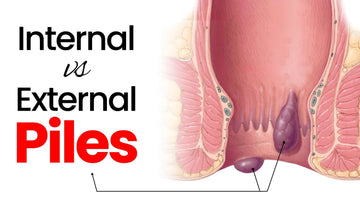 Internal vs. External Piles: What’s the Difference?