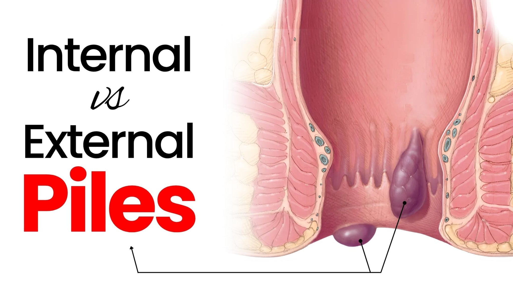 Internal vs. External Piles: What’s the Difference?